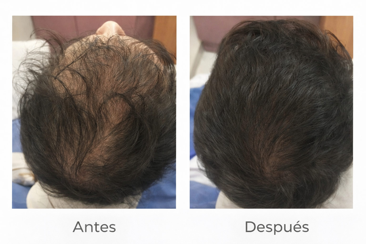 Spectral For Men’s – Recupera tu Cabello